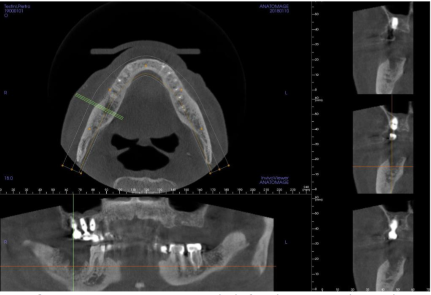 Cone Beam Computer Tomography before the treatment showing the extension of the bone lesion.