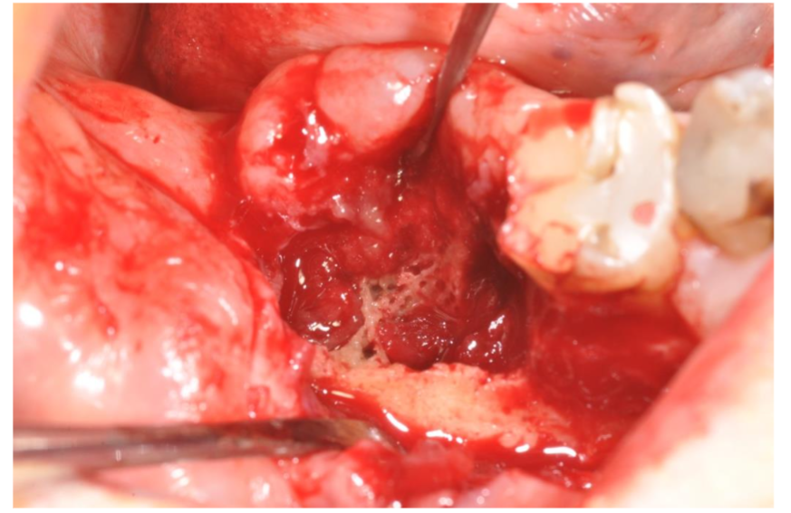 After the removal of the soft pathologic tissue the deepest part of the lesion appeared with necrotic bone mixed with a tissue rich in small vessels.