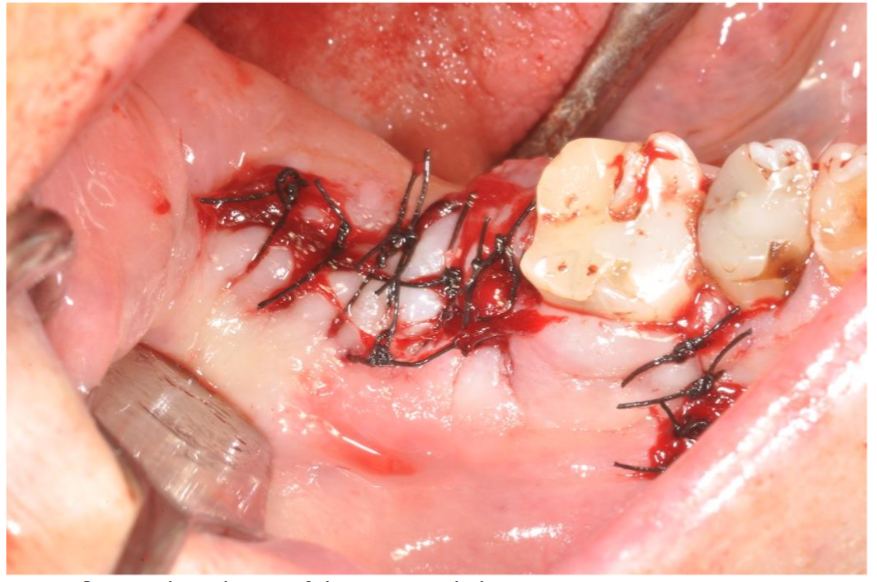 Complete closure of the cavity with the sutures.