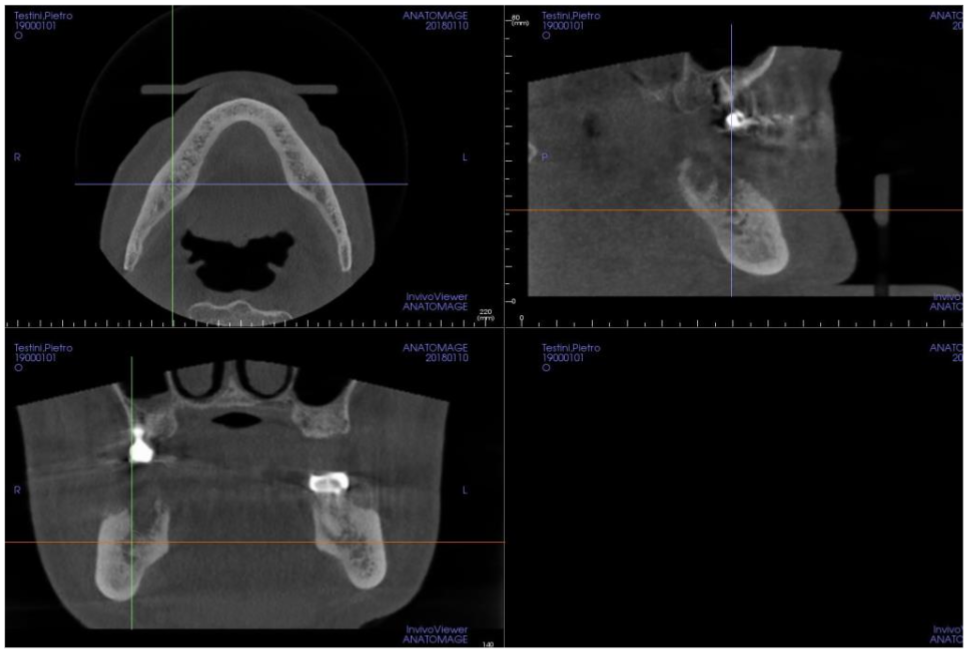 Cone Beam Computer Tomography before the treatment showing the proximity of the lower alveolar nerve on the right side and the pathologic bone, condition that induced radiated pain from the mandible up to the right ear.