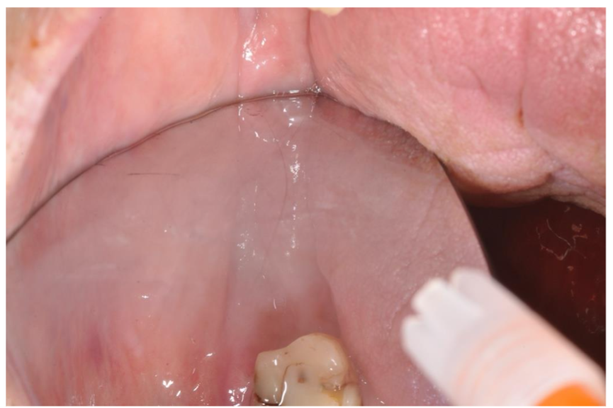 Follow-up after 4 months: the lesion appeared completely healed (the image has been taken using a intraoral mirror).