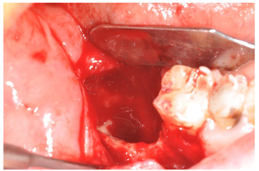 Complete removal of the bone lesion. The exposition of healthy bone is identified by a good bleeding.