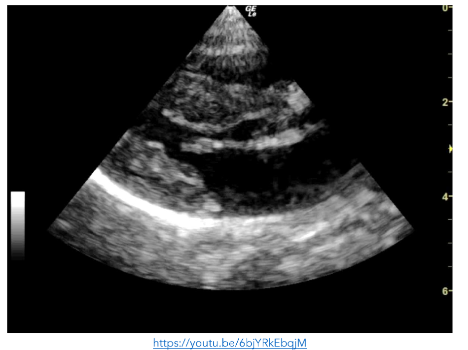 Figure 1: PLAX view showing a hyperdynamic left ventricle.