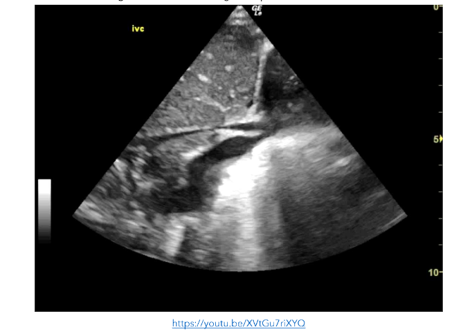Figure 2: PLAX view showing a collapsed and underfilled IVC.