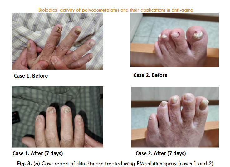 Case report of skin disease treated using PM solution spray (cases 1 and 2).