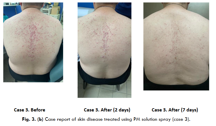 Case report of skin disease treated using PM solution spray (case 3).