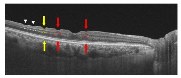 Fig 14: Macular hole surgery end points.