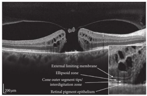 Fig 1: SD-OCT scan showing a small operculum on the roof of the macular hole.