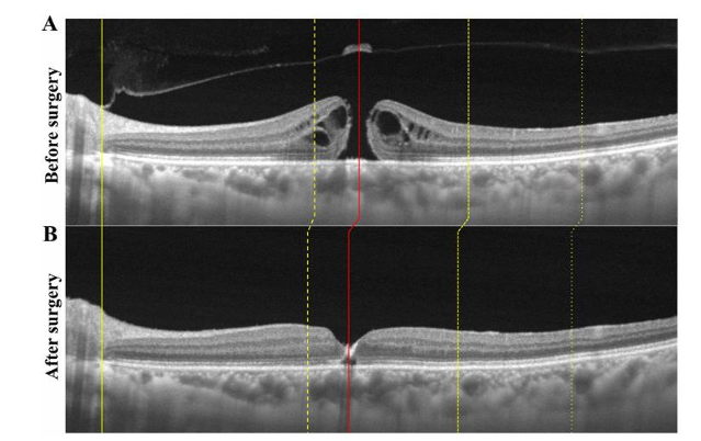 Fig 17: ERM 8 months postoperative created a MH.