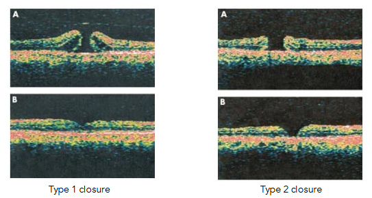 Fig 18: Reduction of FAZ area post successful MH surgery.