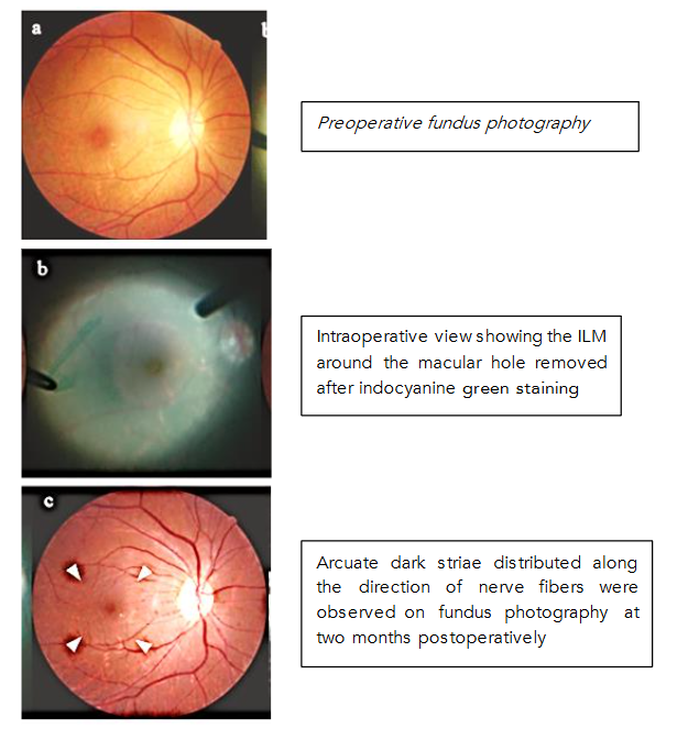 Fig 9: Inner retinal dimpling observed in the area where the ILM was peeled to create the flap.