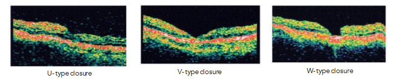 Fig 19: Pre and post operative OCTA measurement of the distances between the bifurcations of two sets of retinal vessels that cross the macula.