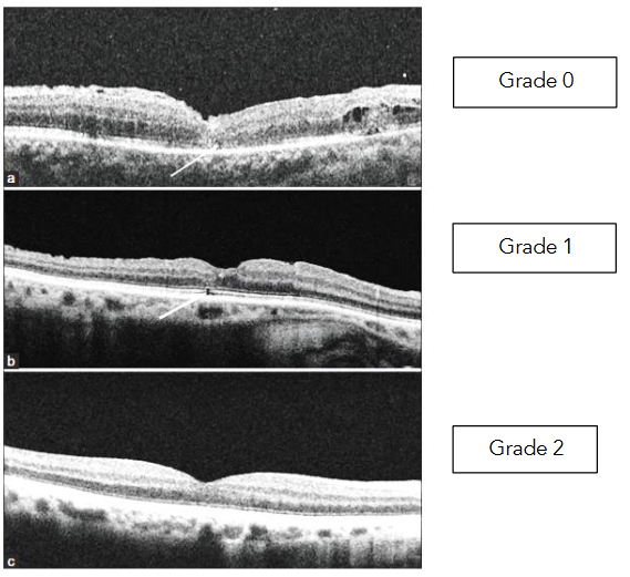 Fig 3: Foveal detachment following successful macular hole surgery.