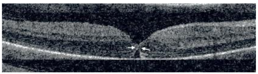 Fig 5: Glial sealing defined as a hyper-reflective lesion that replaced normal foveal retinal layers, including the external limiting membrane and the EZ.