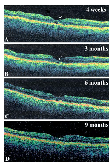 Fig 6: Age related subfoveal deposits post successful macular hole surgery.