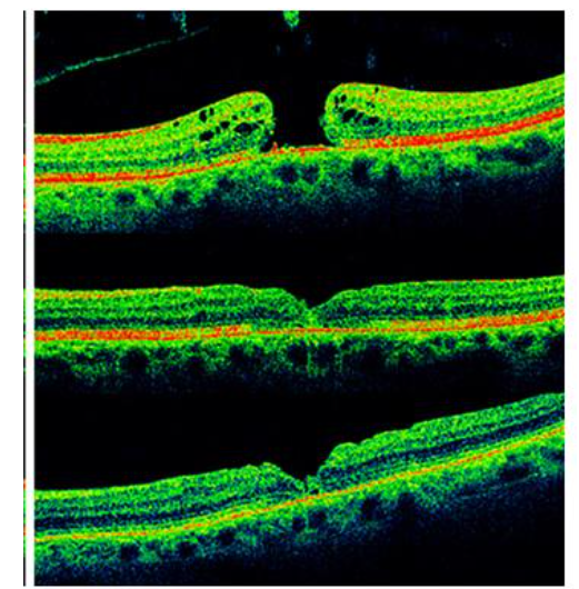 Fig 7: Dissociated optic nerve fiber layer appeared on fundus photography as arcuate, slightly dark, extramacular striae along the course of optic nerve fiber.