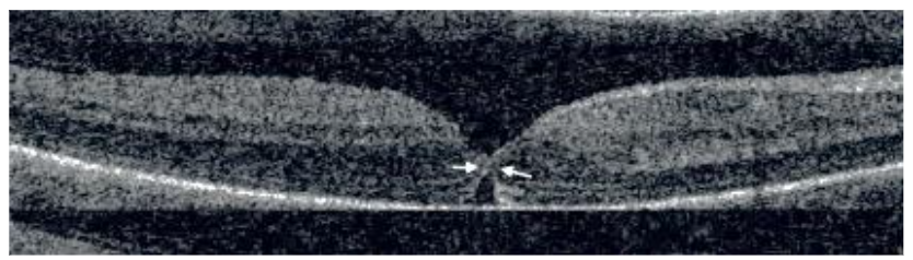 Fig 4: Macular lucencies following successful macular hole surgery and their disappearance by time.
