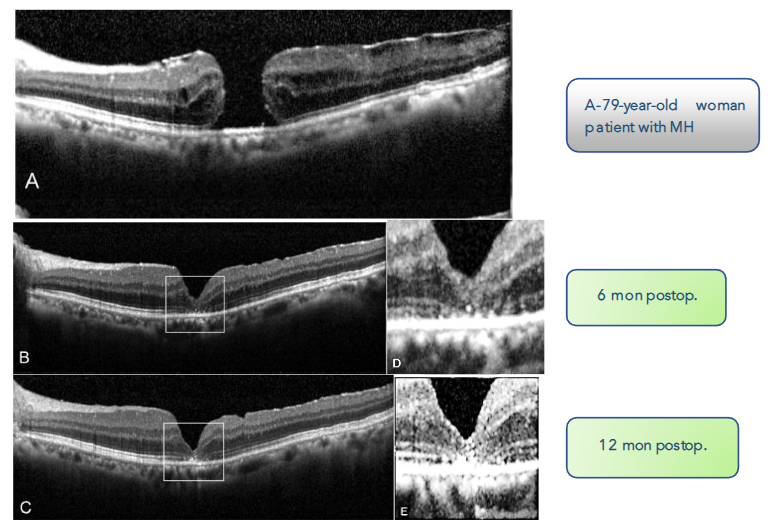 Fig 8: DONFLs progression in the postoperative period.