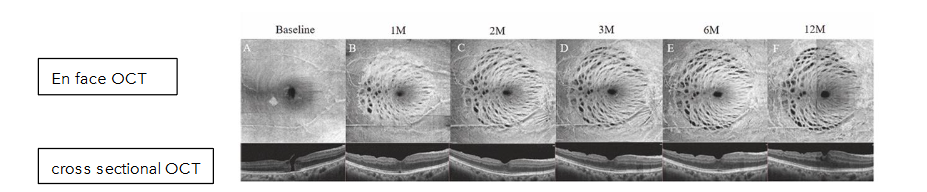 Fig 10: Unidirectional, bidirectional, and complicated bidirectional dimples.
