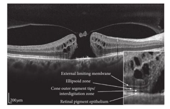 Fig 1: SD-OCT scan showing a small operculum on the roof of the macular hole.