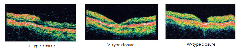 Fig 17: ERM 8 months postoperative created a MH.