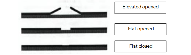 Fig 18: Reduction of FAZ area post successful MH surgery.