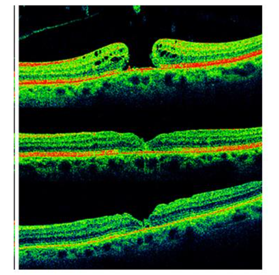 Fig 6: Age related subfoveal deposits post successful macular hole surgery.