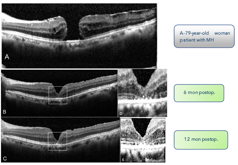 Fig 7: Dissociated optic nerve fiber layer appeared on fundus photography as arcuate, slightly dark, extramacular striae along the course of optic nerve fiber.