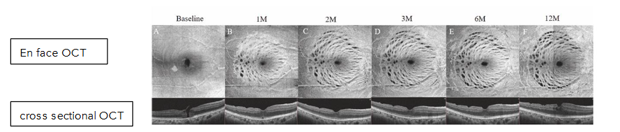 Fig 9: Intraoperative view showing the ILM around the macular hole removed after indocyanine green staining.