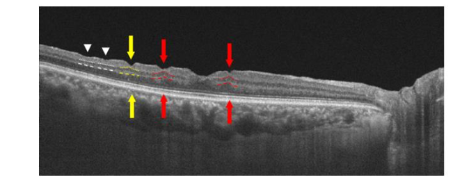 Fig 11: OCT pre and 2 weeks after successful macular hole surgery showing the displacement of the retina and choroid.