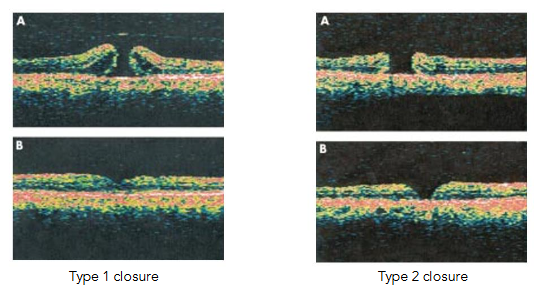 Fig 16: Extensive post operative formation of MH macular edema.