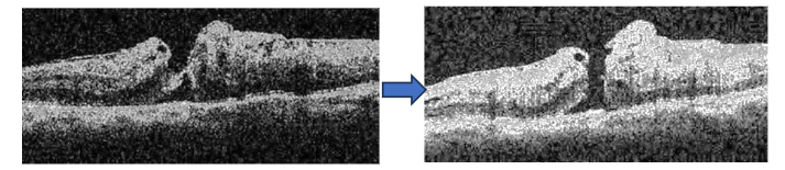 Fig 19: Pre and post operative OCTA measurement of the distances between the bifurcations of two sets of retinal vessels that cross the macula.