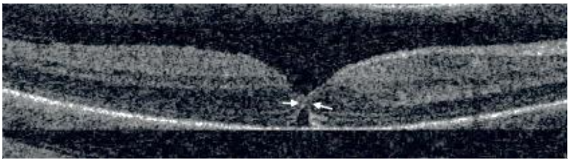 Fig 4: Macular lucencies following successful macular hole surgery and their disappearance by time.