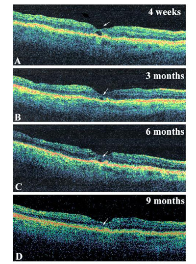 Fig 5: Glial sealing defined as a hyper-reflective lesion that replaced normal foveal retinal layers, including the external limiting membrane and the EZ.