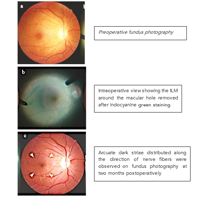 Fig 8: DONFLs progression in the postoperative period.
