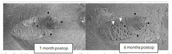 Fig 10: Unidirectional, bidirectional, and complicated bidirectional dimples.