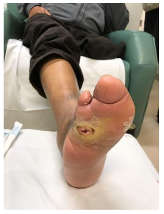 Complete wound healing in 7 weeks.