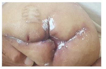 Rx. healing occurred 28 days after treatment with CPZO.