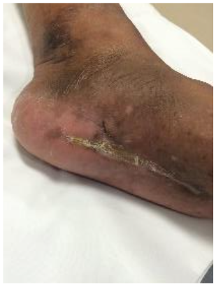 Male patient treated elsewhere initially, 56 y.o., DM2.