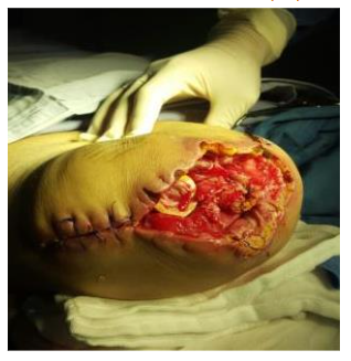 Male patient, 68 y. o., DM2, treated elsewhere for diabetic foot, very complicated, 3 previous amputations failed.