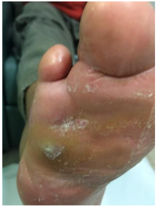 Foot ulcer healing was achieved in 8 weeks.