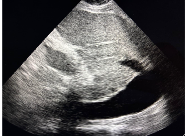Figure 12: Preoperative cardiac POCUS showing aortic stenosis not previously reported in a patient with femur fractures.