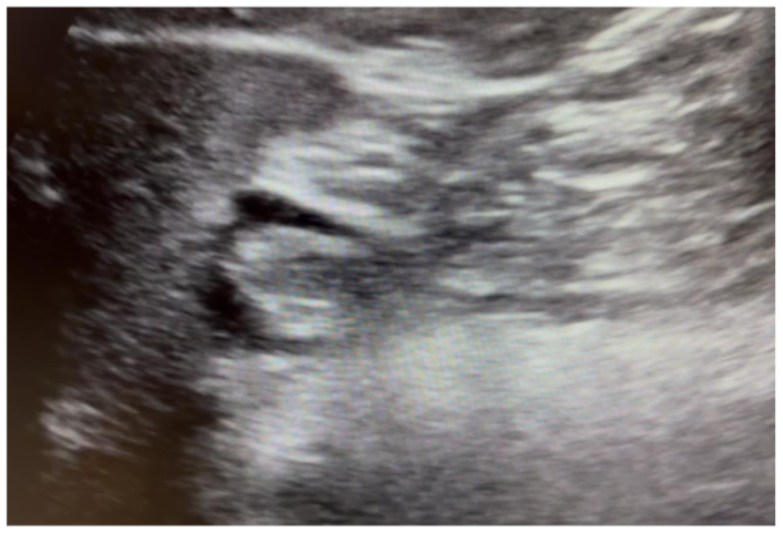Figure 2: Gastric POCUS - Full Stomach: Clear Fluid