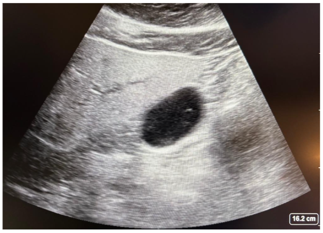 Figure 3: Gastric POCUS - Full Stomach: Solid Late Stage