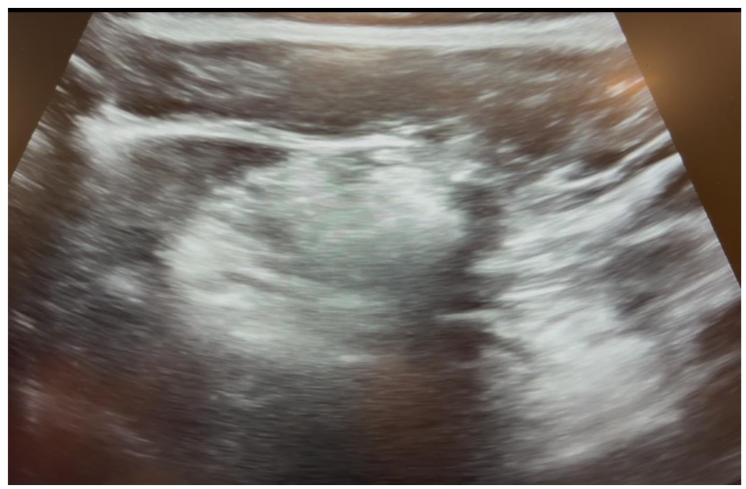 Figure 5: Lung POCUS