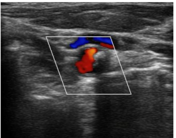 Figure 7: Inferior Vena Cava US