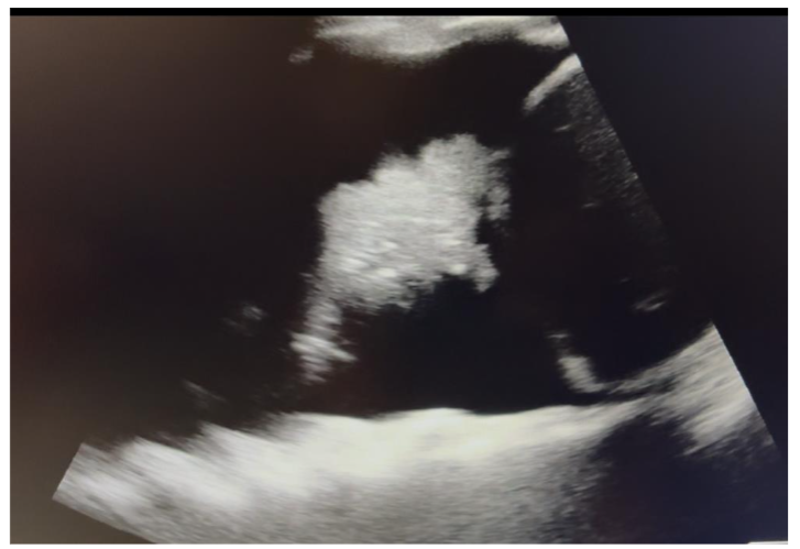 Figure 8: Inferior Vena Cava US