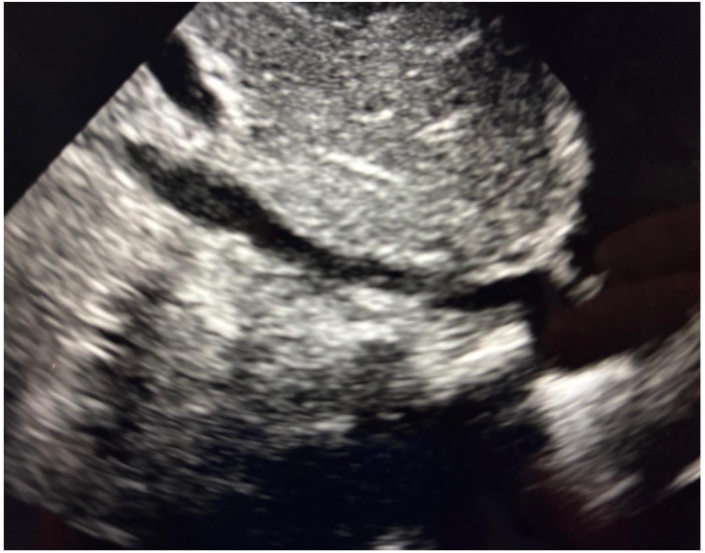 Figure 11: Preoperative cardiac POCUS (Parasternal long-axis view)