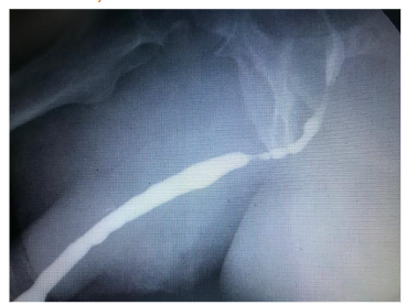 Figure 2: Urethral stricture due to insufficient lubrication of the catheter and urethra at the start of insertion.
