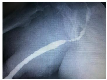 Figure 2: Urethral stricture due to insufficient lubrication of the catheter and urethra at the start of insertion.